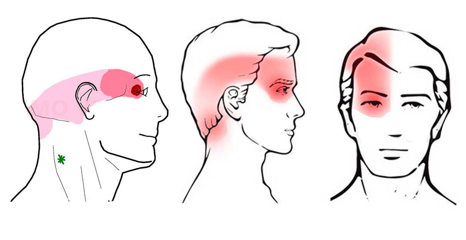 Origen del Dolor en la cefalea tensional o de origen cervical